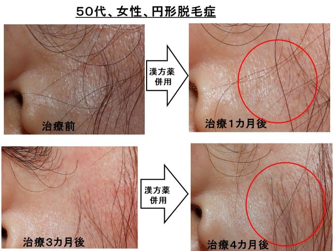 円形脱毛症　病院